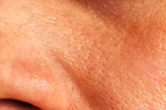 脸部毛孔粗大怎么办（毛孔粗大有办法缩小吗）