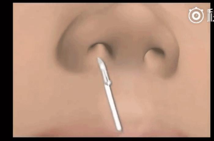 假体隆鼻手术（隆鼻手术过程全程动图演示）