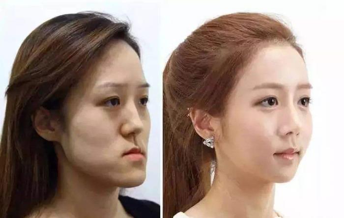 鞋拔子是什么鞋拔子脸也是一种病