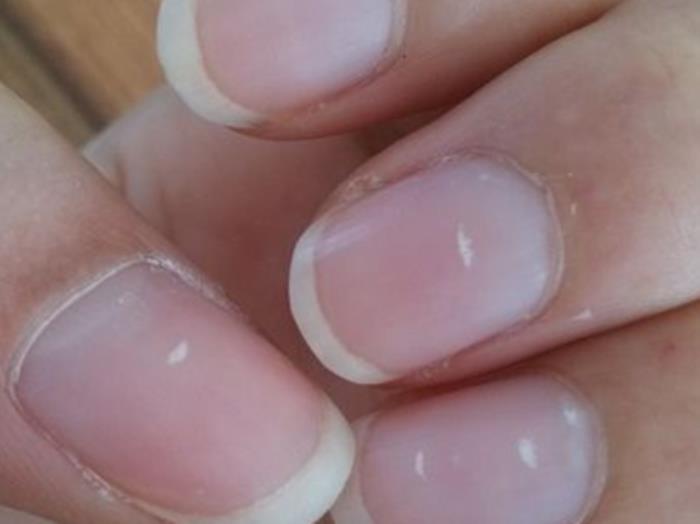 指甲上有白色斑点（指甲变化与健康有哪些关联）