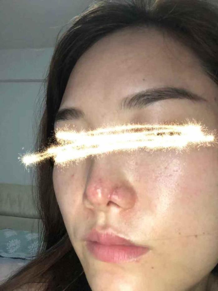 注射隆鼻医院（玻尿酸隆鼻后皮肤溃烂）