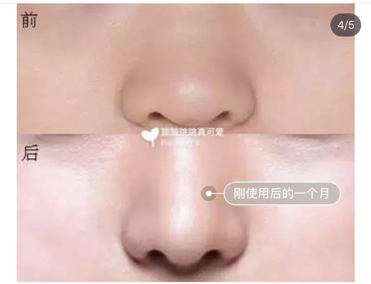 怎么让鼻孔变小（千万别学这4个缩鼻孔方法）(12)