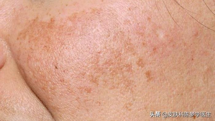 维生素a乳膏火爆全网的维a酸乳膏