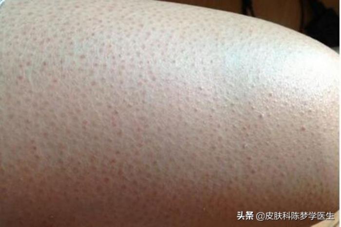 有鸡皮肤就是缺维生素a吗(鸡皮肤是缺少维生素a还是维生素b) 有鸡皮肤就是缺维生素a吗(鸡皮肤是缺少维生素a还是维生素b)