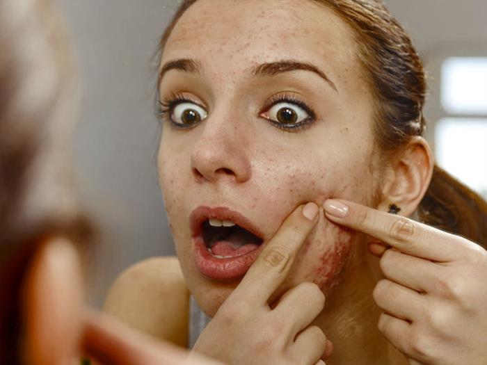 如何快速去青春痘（脸上痘痘怎么快速消除）