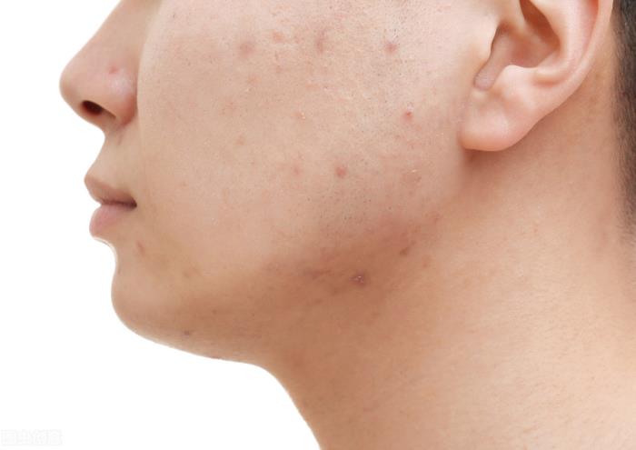 皮肤毛孔大的原因（毛孔粗大的原因是什么）