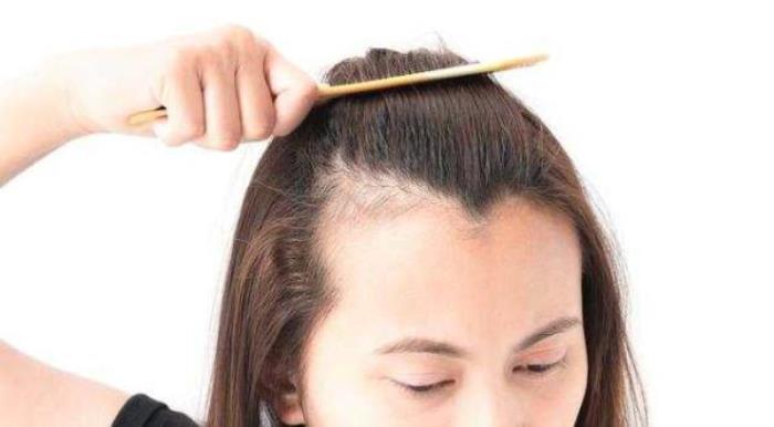 前额头发少怎么办（前额头发稀少怎么办）