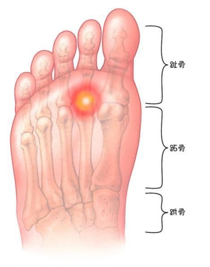 脚踵是哪个部位图解足底不同部位的疼痛