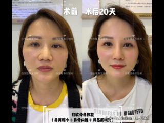 鼻子美容整形（华丽款鼻整形合集—并非人人适配）