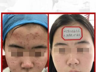 额头长逗是什么原因（是让你额头长痘痘的罪魁祸首）