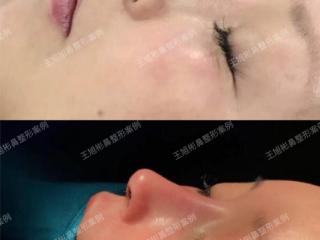 鼻子整形美容（对照11种鼻型整形）