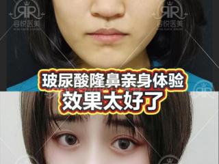 玻尿酸隆鼻效果怎么样（玻尿酸隆鼻亲身体验）