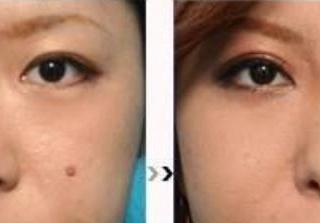 鼻子缩小整形手术（鼻翼缩小整形该怎么做）