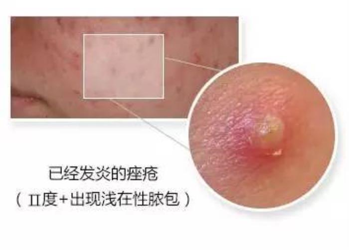 痘痘挤出来的是什么挤痘痘挤出来那坨白色东西是什么