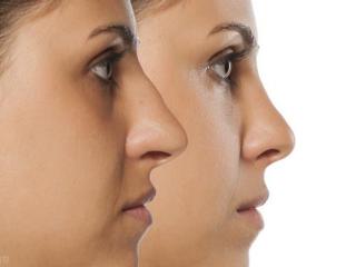 玻尿酸隆鼻效果好吗（玻尿酸隆鼻的好处有哪些）