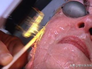 光子嫩肤效果好吗（听说做一次效果不大）