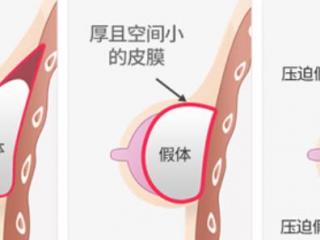 硅胶隆胸价格（价格会有很大差异吗）