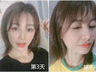 光子嫩肤多少钱做一次（花480元做的光子嫩肤）