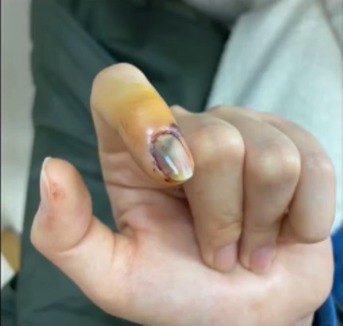 受伤的图片盘点明星拍戏意外受伤