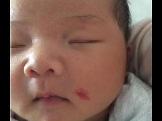 婴儿胎记形成的原因（孕期这3种不良行为也容易有胎记）