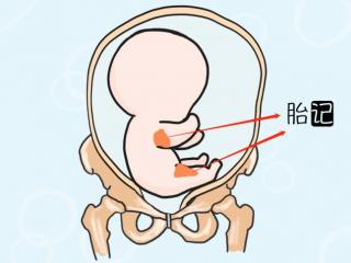 婴儿胎记的成因（宝宝的胎记因何而来）