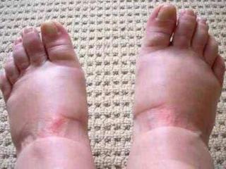 孕期水肿如何缓解（孕妈消除水肿6个小妙招）