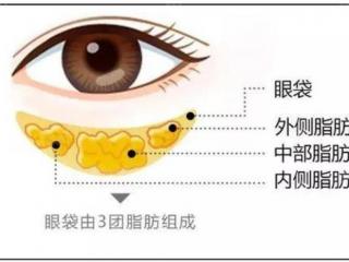 眼袋大是什么原因（造成眼袋大的原因是什么）