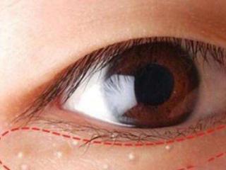 眼部脂肪粒怎么去除（教你轻松几招祛除眼部脂肪粒）