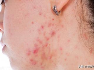 油性皮肤如何去痘痘（油性皮肤老爱长痘痘怎么办）