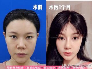 鼻子整形照片（华丽款鼻整形合集—并非人人适配）