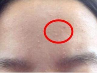 什么是闭口粉刺（你脸上长的小疙瘩是闭口还是黑头）