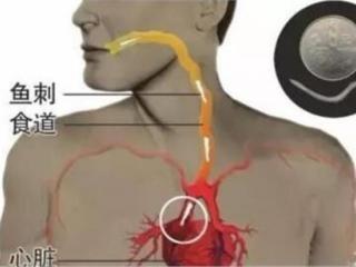 鱼刺卡在喉咙的小方法（鱼刺卡住喉咙的急救方法）