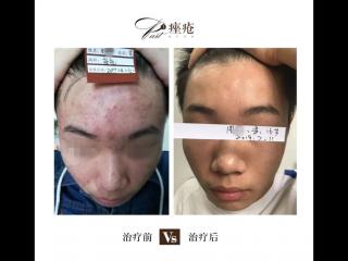 暗疮和粉刺的区别是什么（痤疮和粉刺有什么区别）