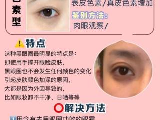 色素型黑眼圈（如何有效地去除色素型的黑眼圈）