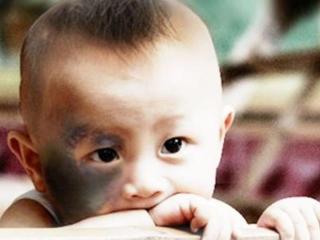 怎样不长胎记（胎记影响孩子的成长）