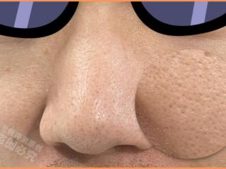 怎么修复毛孔（超全指南解决你的毛孔问题）