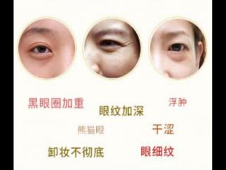 眼部皱纹分类（看看你的眼部细纹是哪种）
