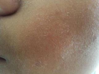 脸上有白色的皮屑（洗完脸后还有白色皮屑）