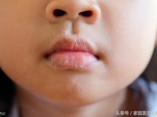 嘴唇脱皮是缺维生素几（这代表你体内缺乏2种维生素）