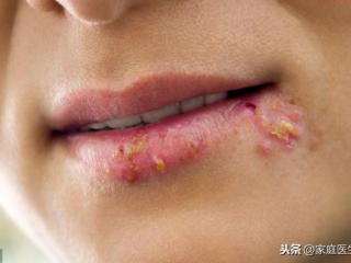 嘴角长泡怎么办（嘴角起泡应该怎么处理）