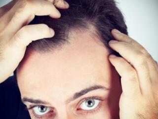 头发出油脱发怎么治（头发出油脱发怎么办）