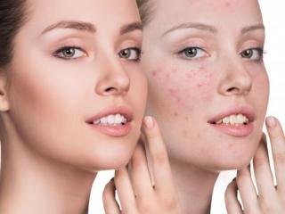 清除脸上的螨虫（怎样除掉脸上的螨虫）