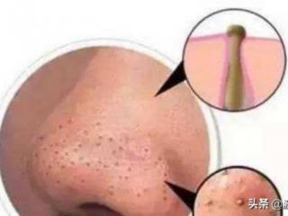 男士脸部毛孔粗大怎么办（男士毛孔粗大怎么办呀）