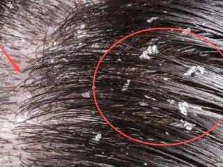 什么洗发水去屑效果好（哪种洗发水的去屑能力强）