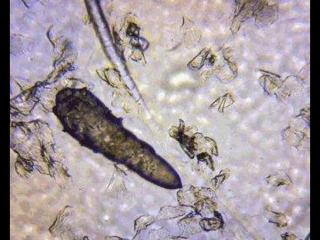 脸上有螨虫怎么去除（发现脸上有螨虫要怎么解决）