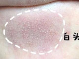 闭口和痘痘的区别图（你以为的闭口可能真的不是闭口）