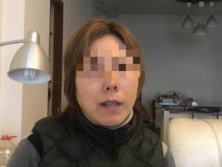 鼻子整形前后对比图（成都一女士整形后却变成朝天鼻）