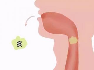 白痰和黄痰哪个更严重一点，哪个更严重