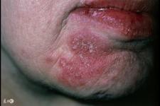 周海媚红斑狼疮（周海媚曾患红斑狼疮）