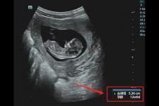 怀孕三个月的胎儿图（怀孕三个月的胎儿是什么样子的）